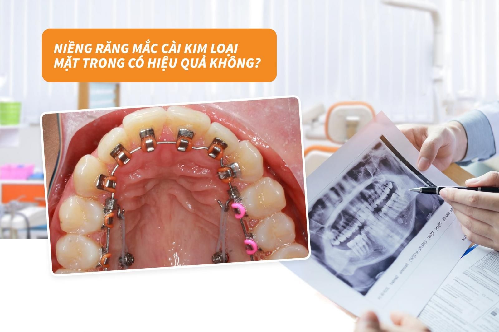 Niềng răng mắc cài kim loại mặt trong có hiệu quả không? 