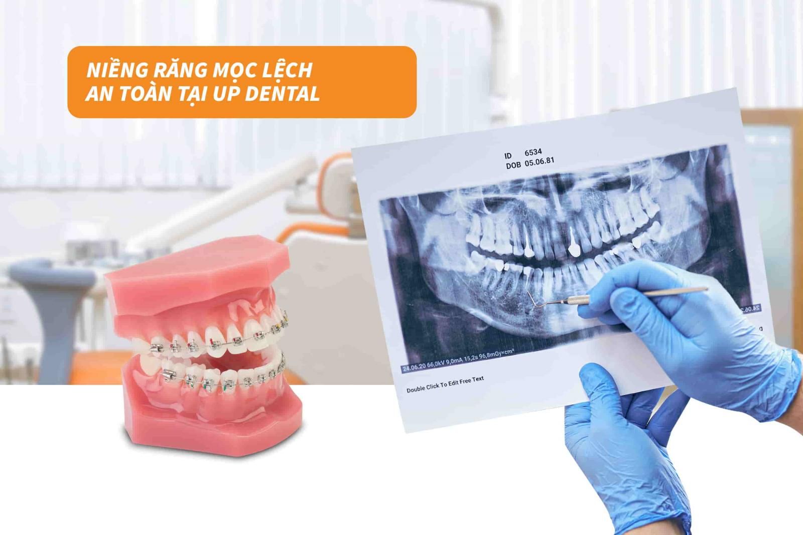 Niềng răng mọc lệch an toàn tại Up Dental