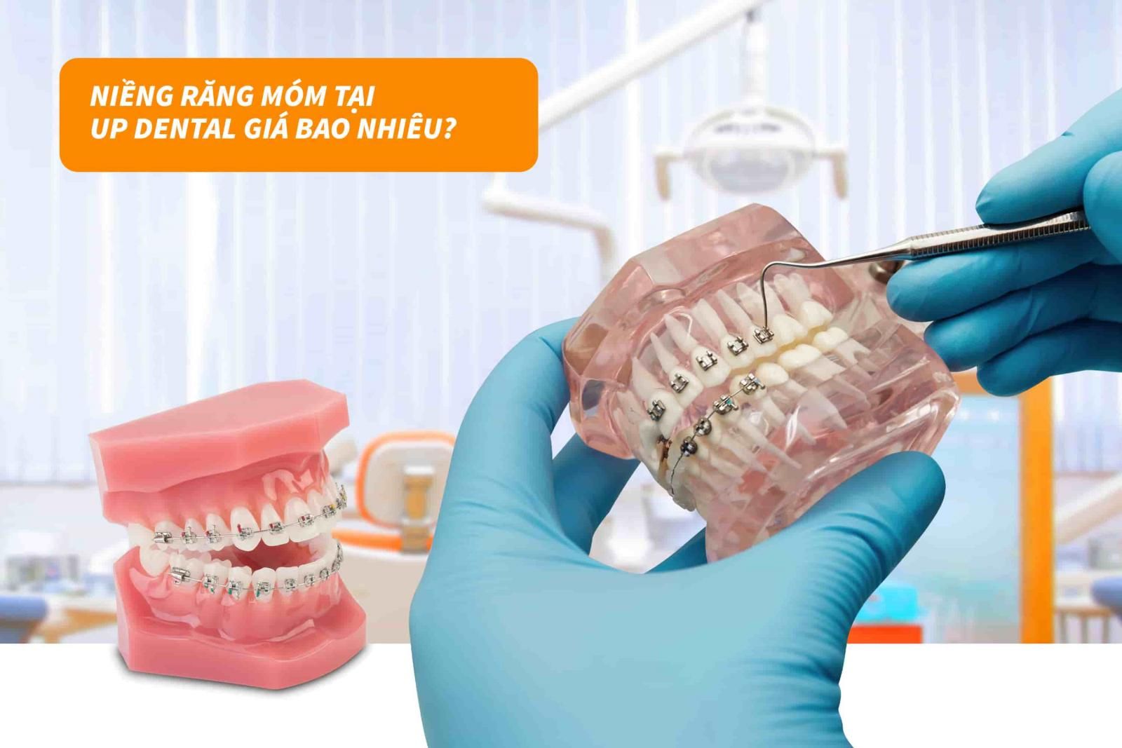 Chi phí niềng răng móm là bao nhiêu tại nha khoa Up Dental