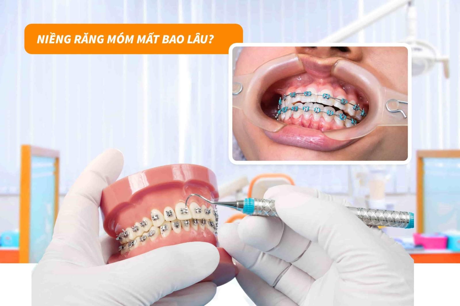 Niềng răng móm mất bao lâu?