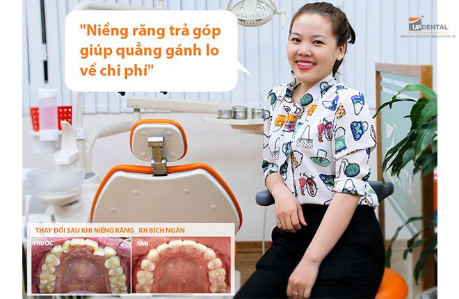 nieng-rang-tra-gop-tai-up-dental