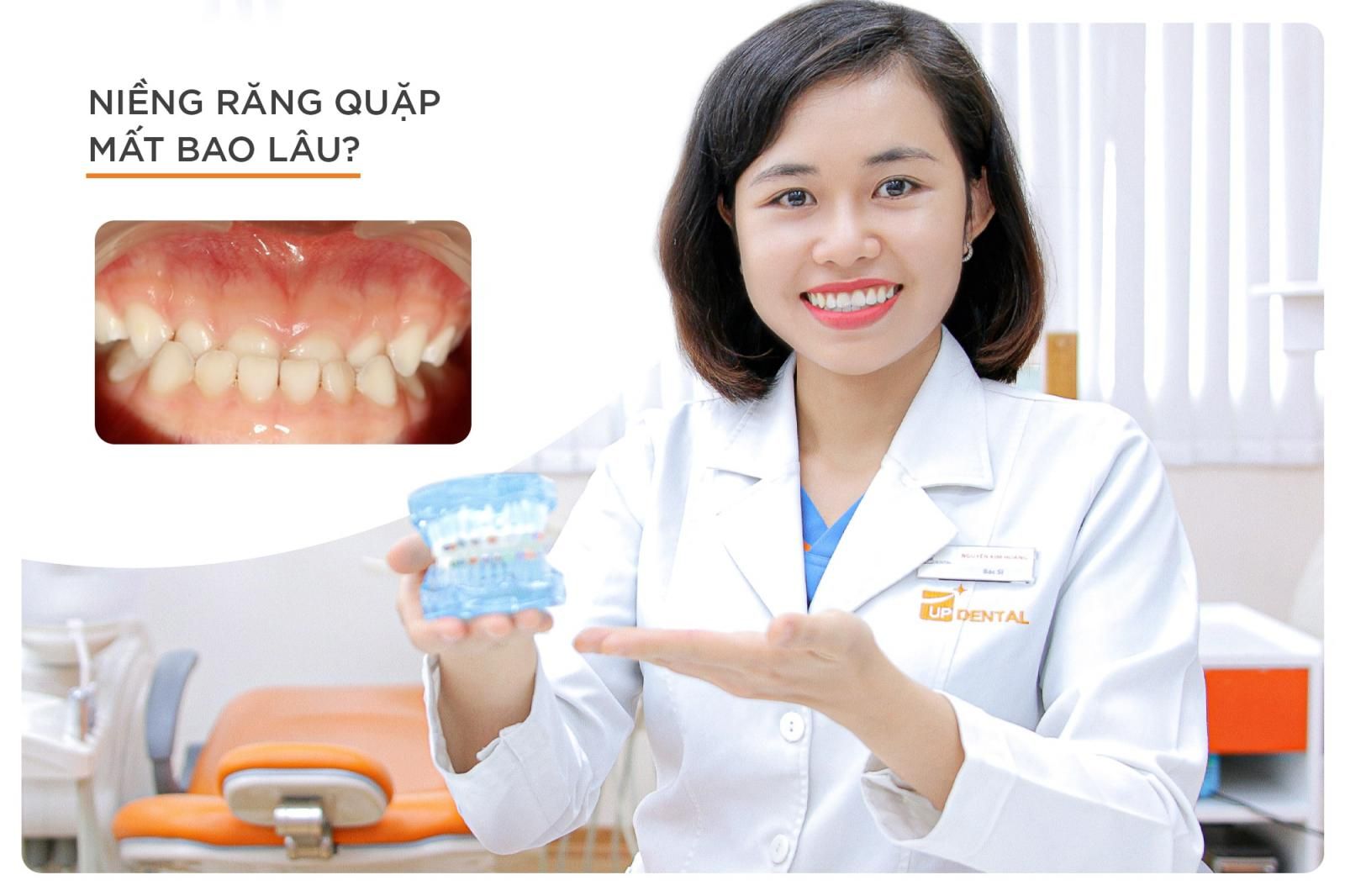 niềng răng quặp mất bao lâu