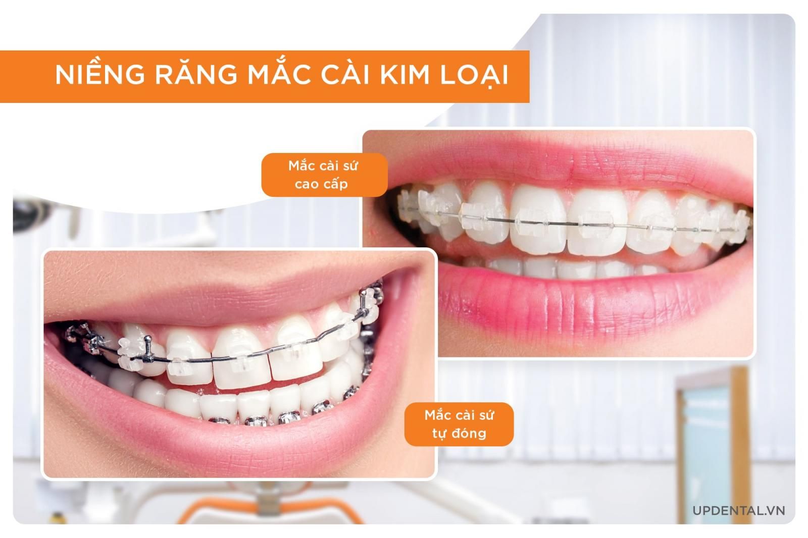 niềng răng mắc cài sứ