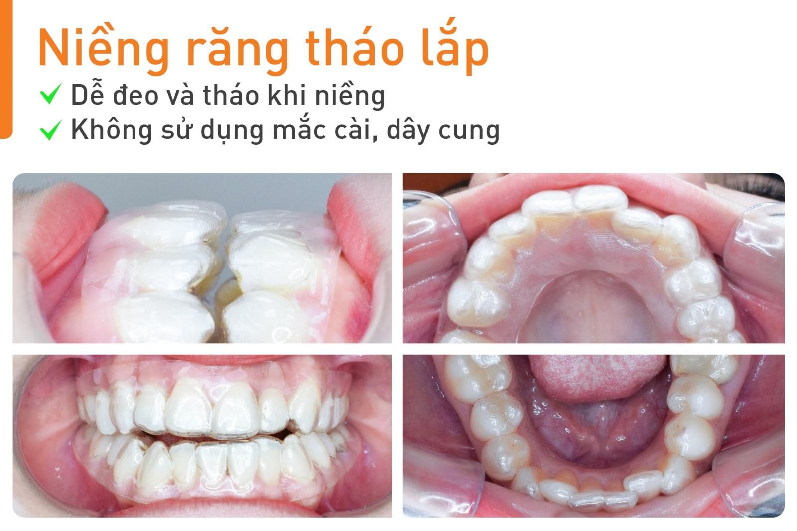 phương pháp niềng răng tháo lắp