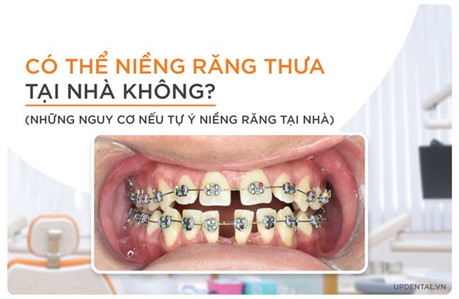 có thể niềng răng cửa bị thưa tại nhà không