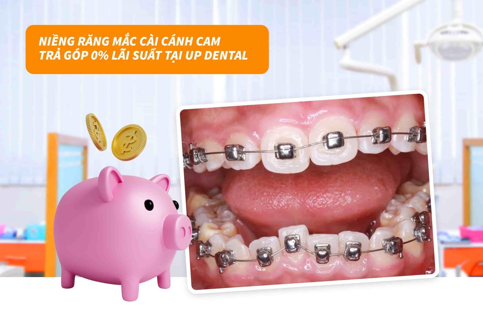 1. Chính sách niềng răng trả góp chỉ từ 1 triệu/tháng của Up Dental