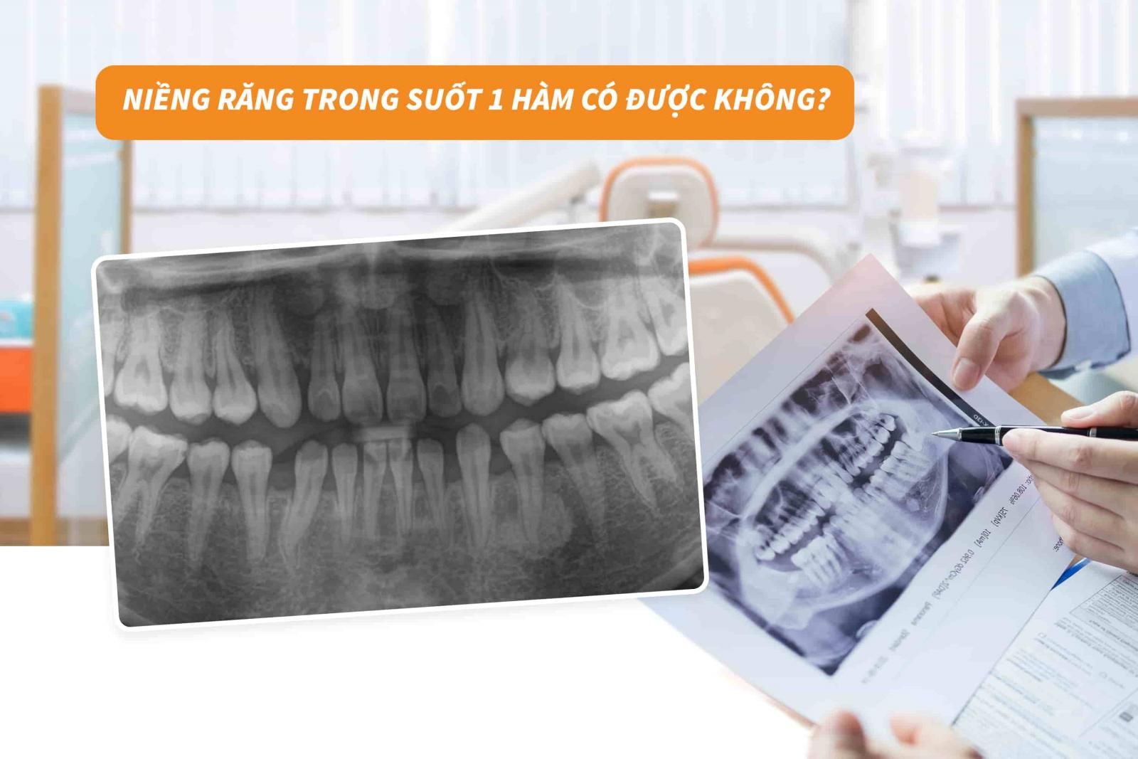 Niềng răng trong suốt 1 hàm có được không?