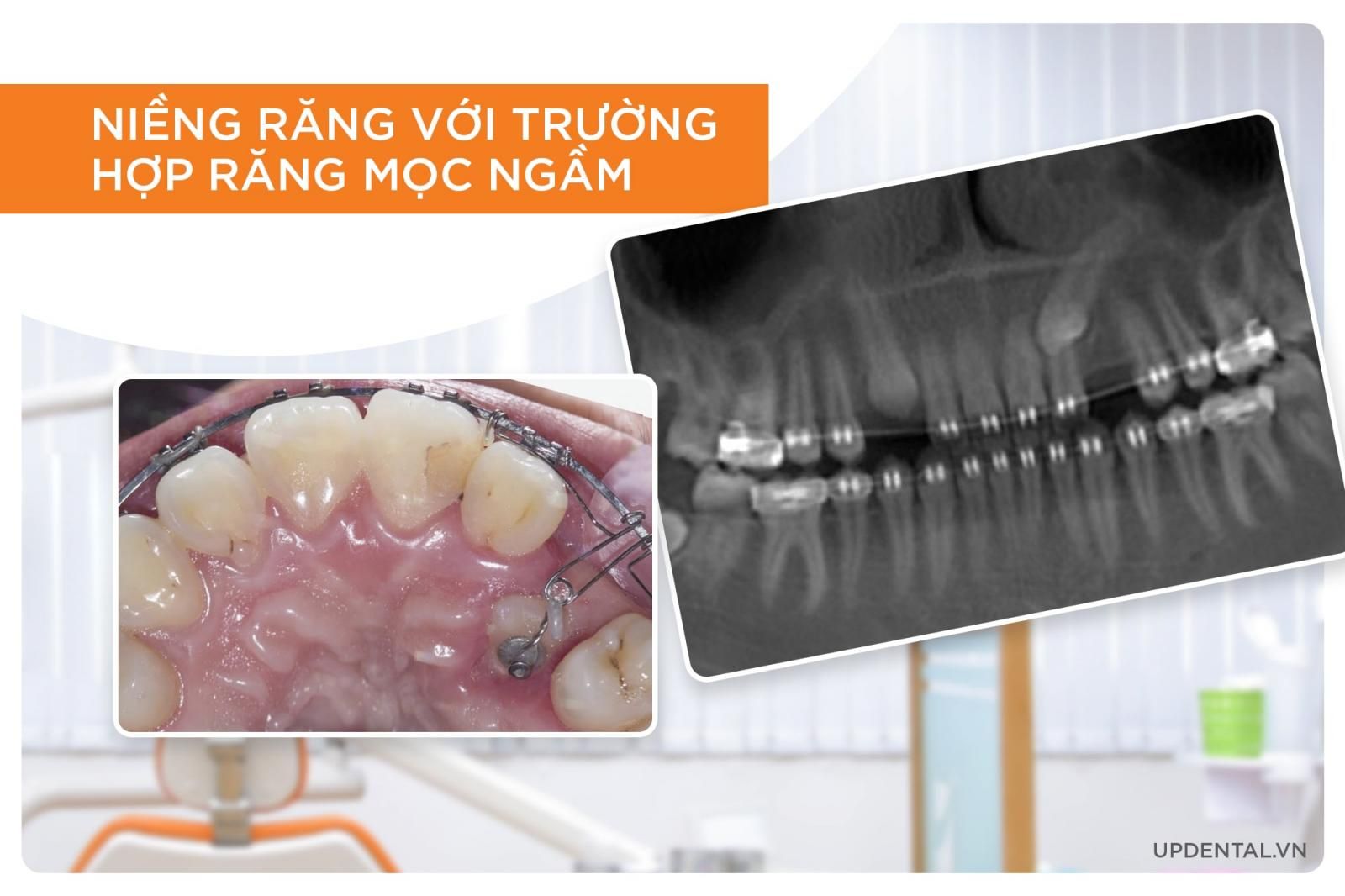 niềng răng up dental