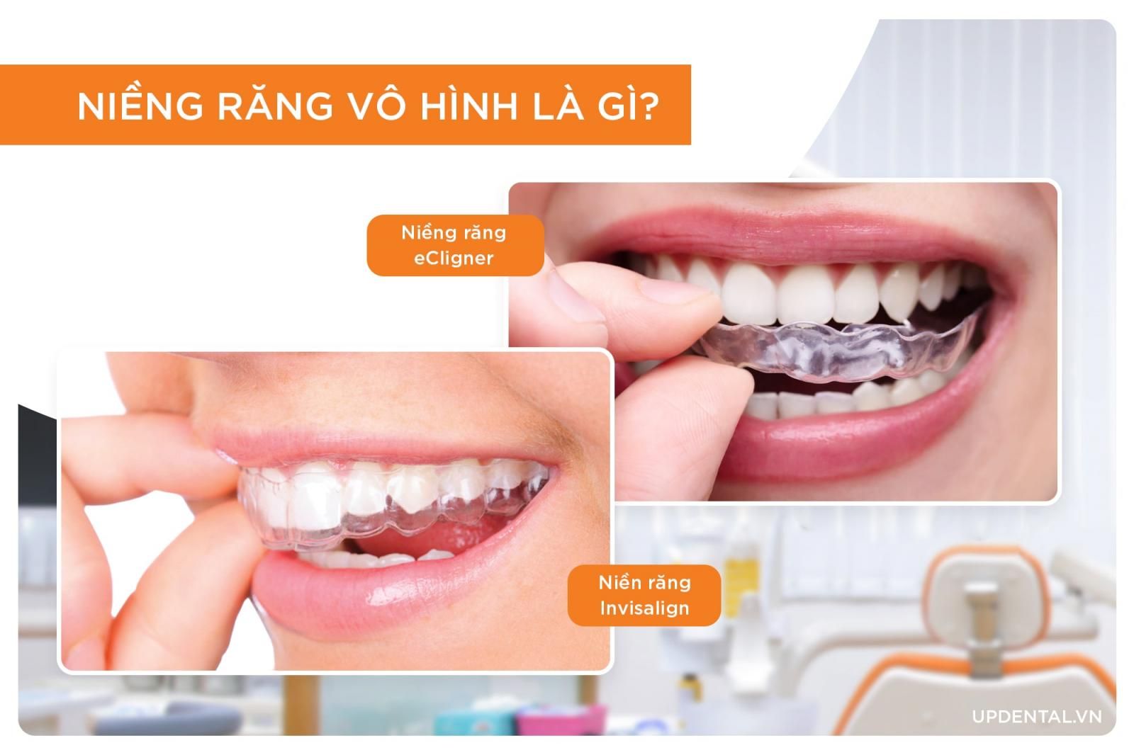 niềng răng vô hình là gì