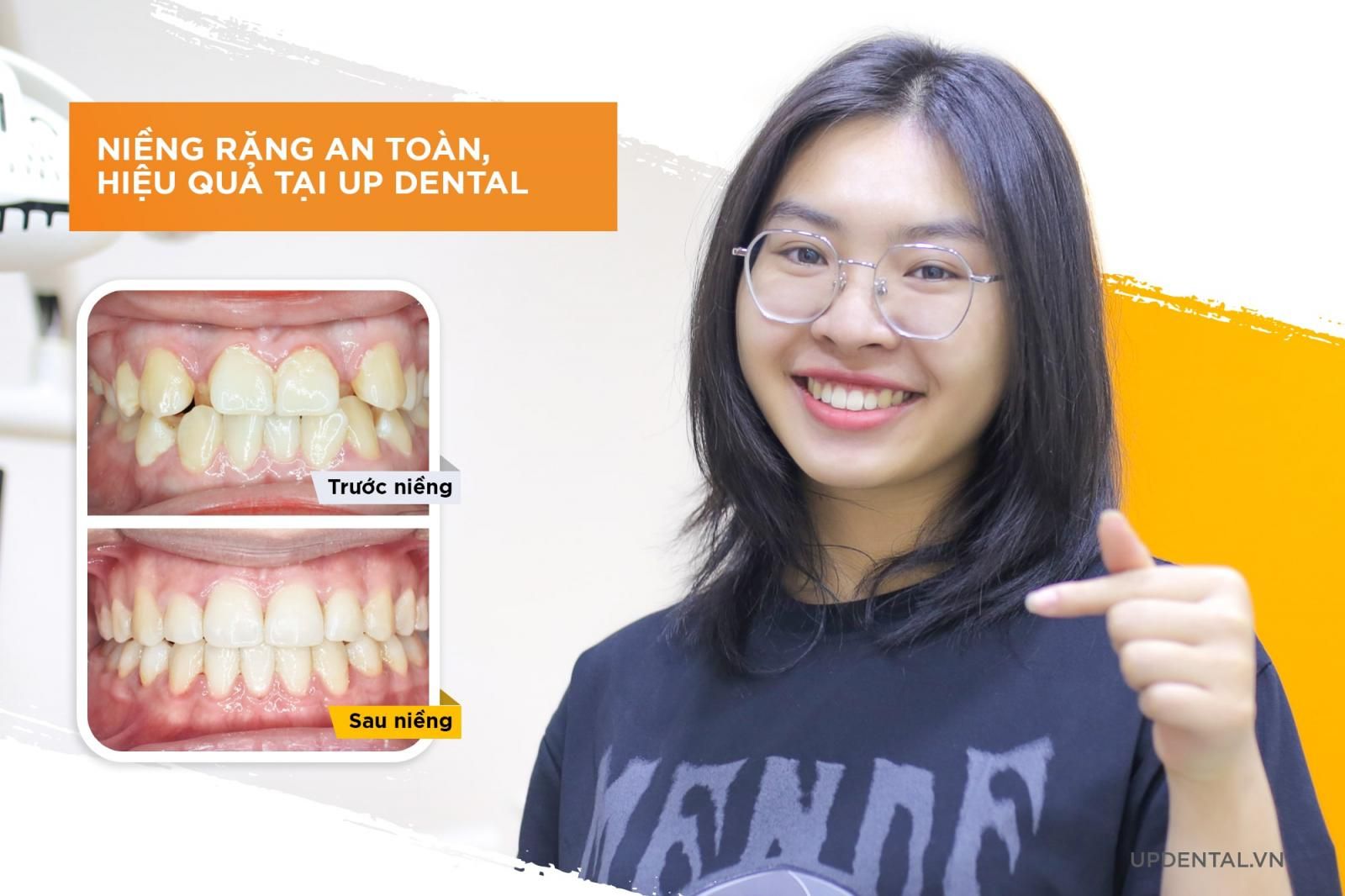 Niềng răng an toàn tại Up Dental