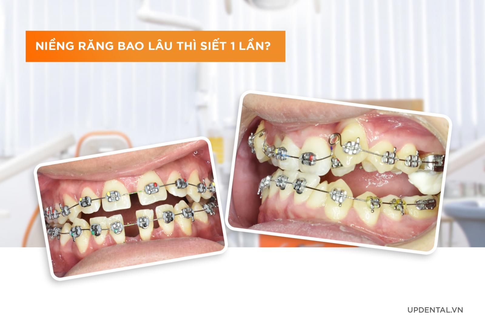 Niềng răng bao lâu siết một lần