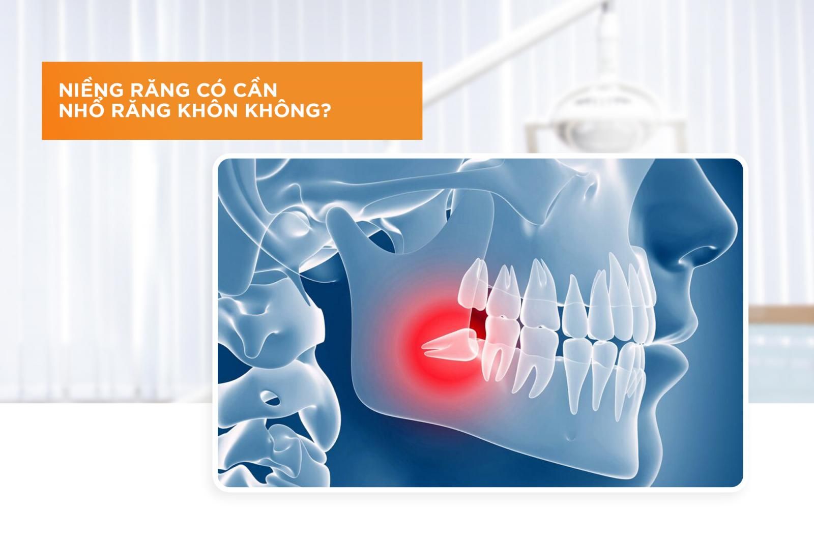 Niềng răng có phải nhổ răng khôn