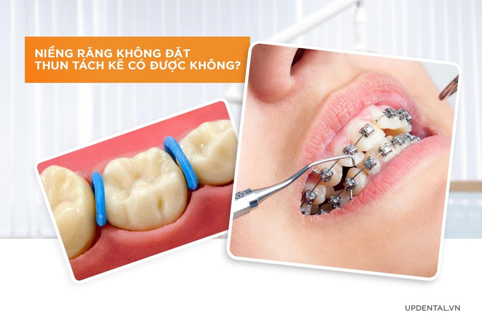 Niềng răng không đặt thun tách kẽ