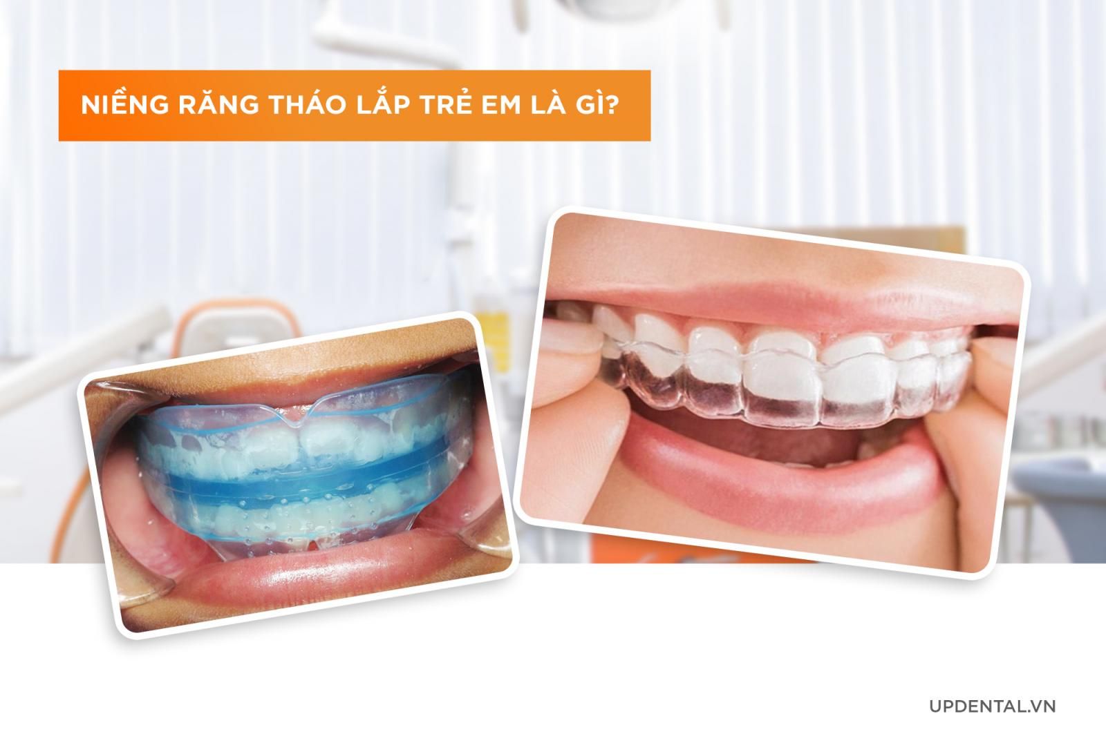 Niềng răng tháo lắp trẻ em là gì