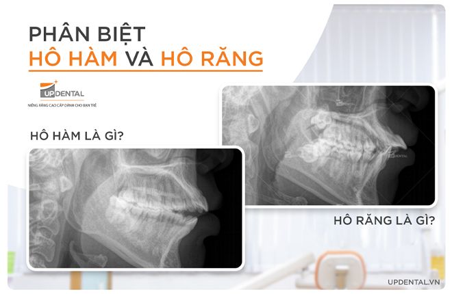 phân biệt hô hàm và hô răng