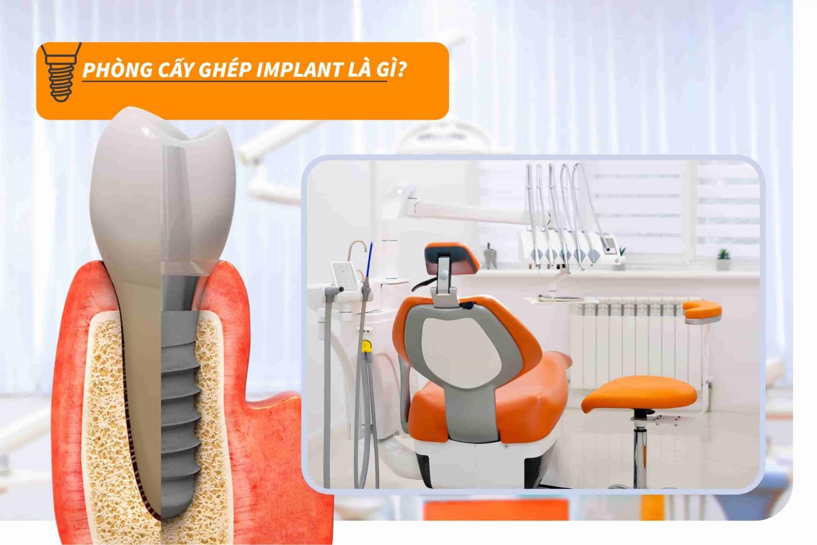 Phòng cấy ghép Implant là gì?