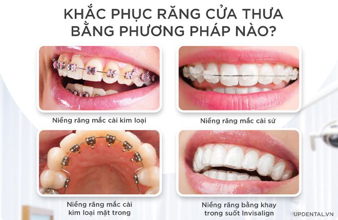 các phương pháp niềng răng thưa