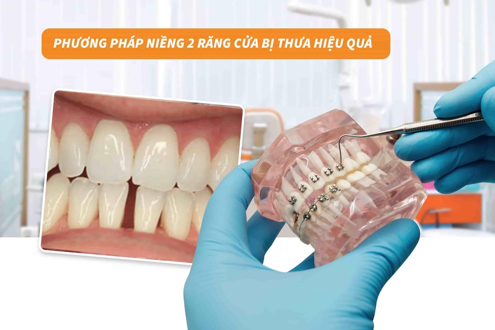 Phương pháp niềng 2 răng cửa bị thưa hiệu quả 