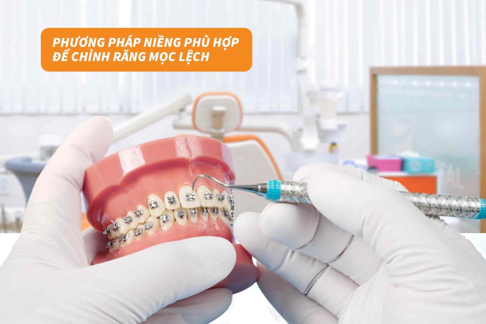 Phương pháp niềng phù hợp để chỉnh răng mọc lệch