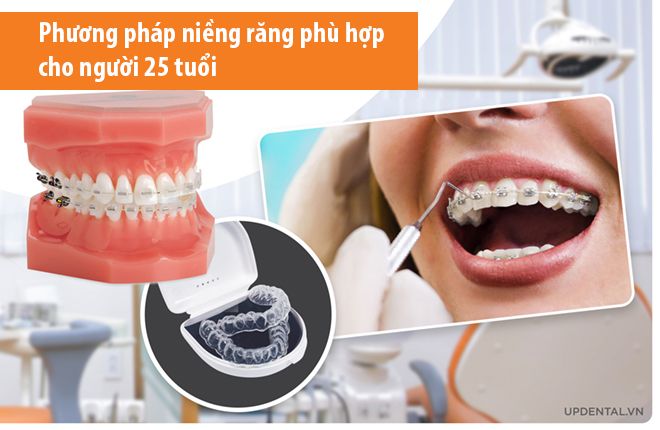 phương pháp niềng răng cho người 25 tuổi