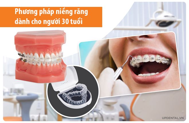 Phương pháp niềng răng dành cho người 30 tuổi