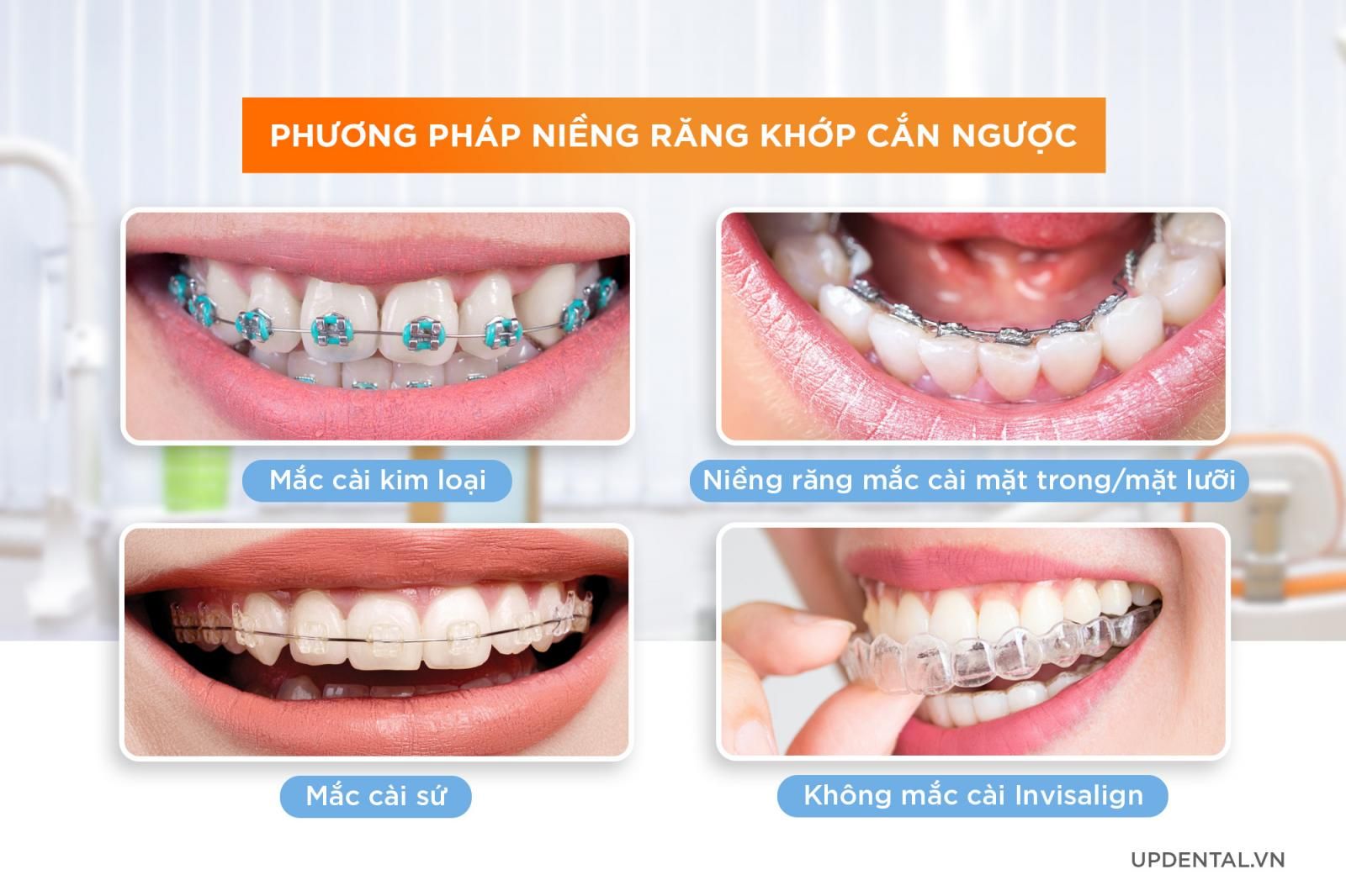 4 phương pháp niềng răng khớp cắn ngược