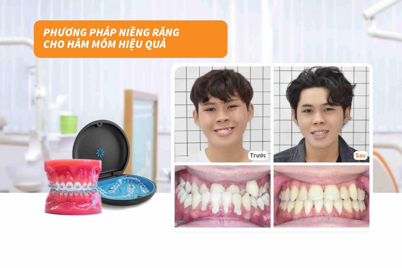 Phương pháp niềng răng cho hàm móm hiệu quả 