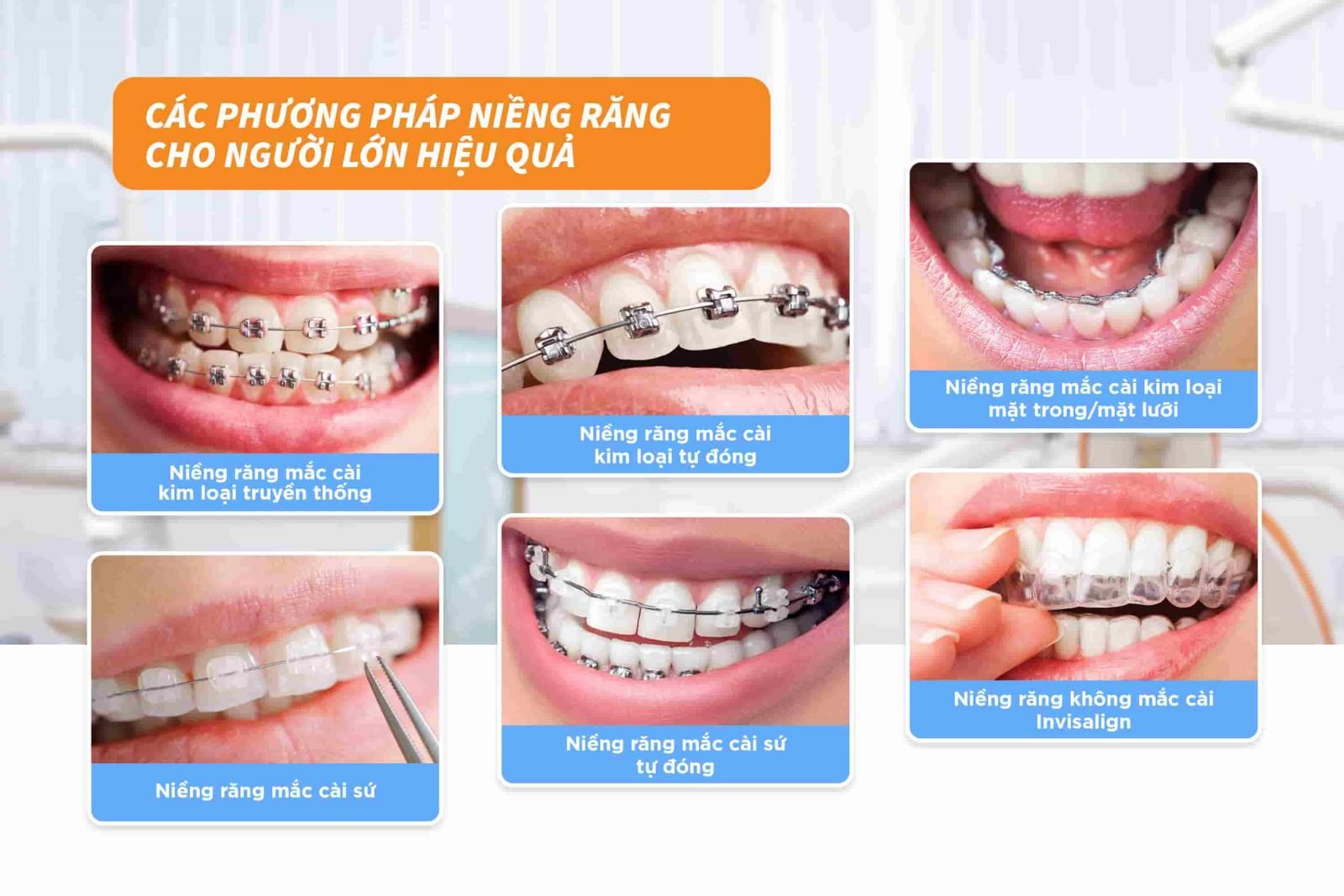 Các phương pháp niềng răng cho người lớn hiệu quả 