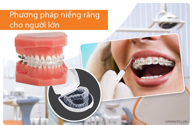 phương pháp niềng răng