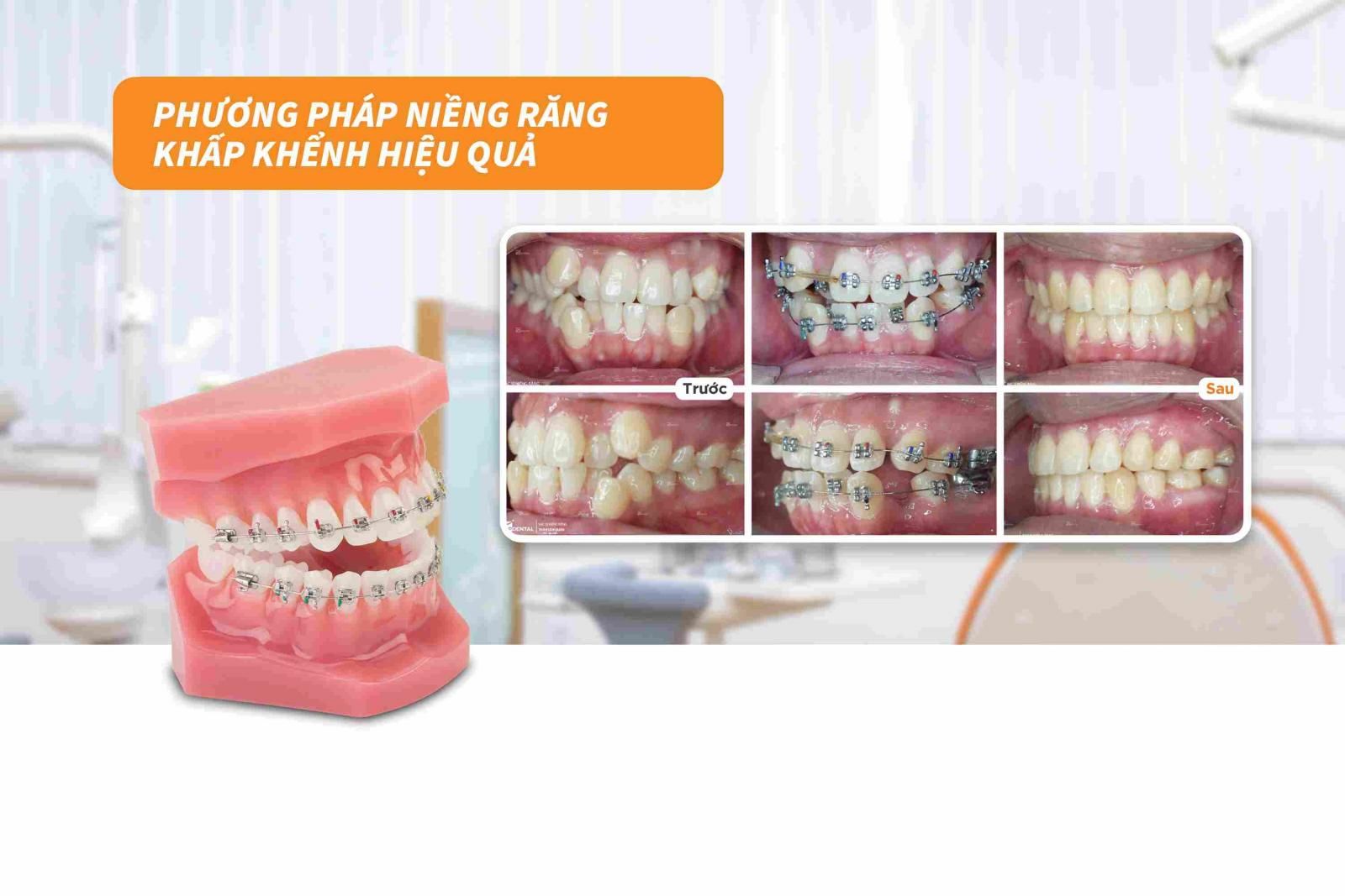 Phương pháp niềng răng khấp khểnh hiệu quả