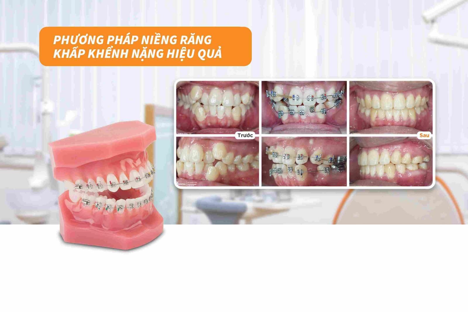 Phương pháp niềng răng khấp khểnh nặng hiệu quả