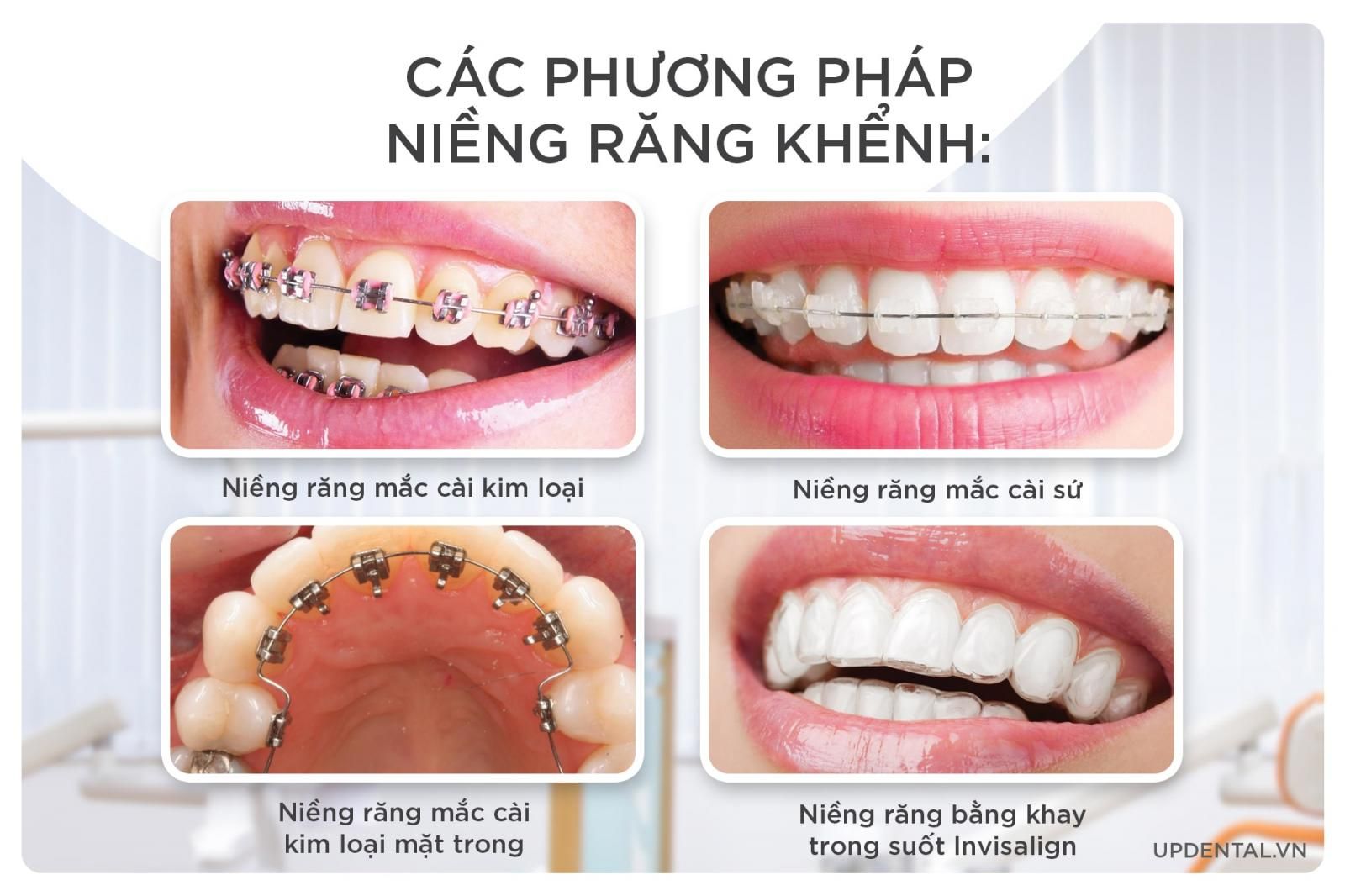 các phương pháp niềng răng khểnh