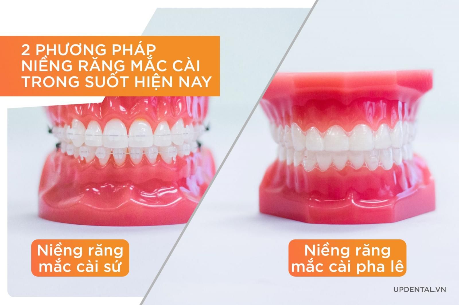 2 phương pháp niềng răng mắc cài trong suốt