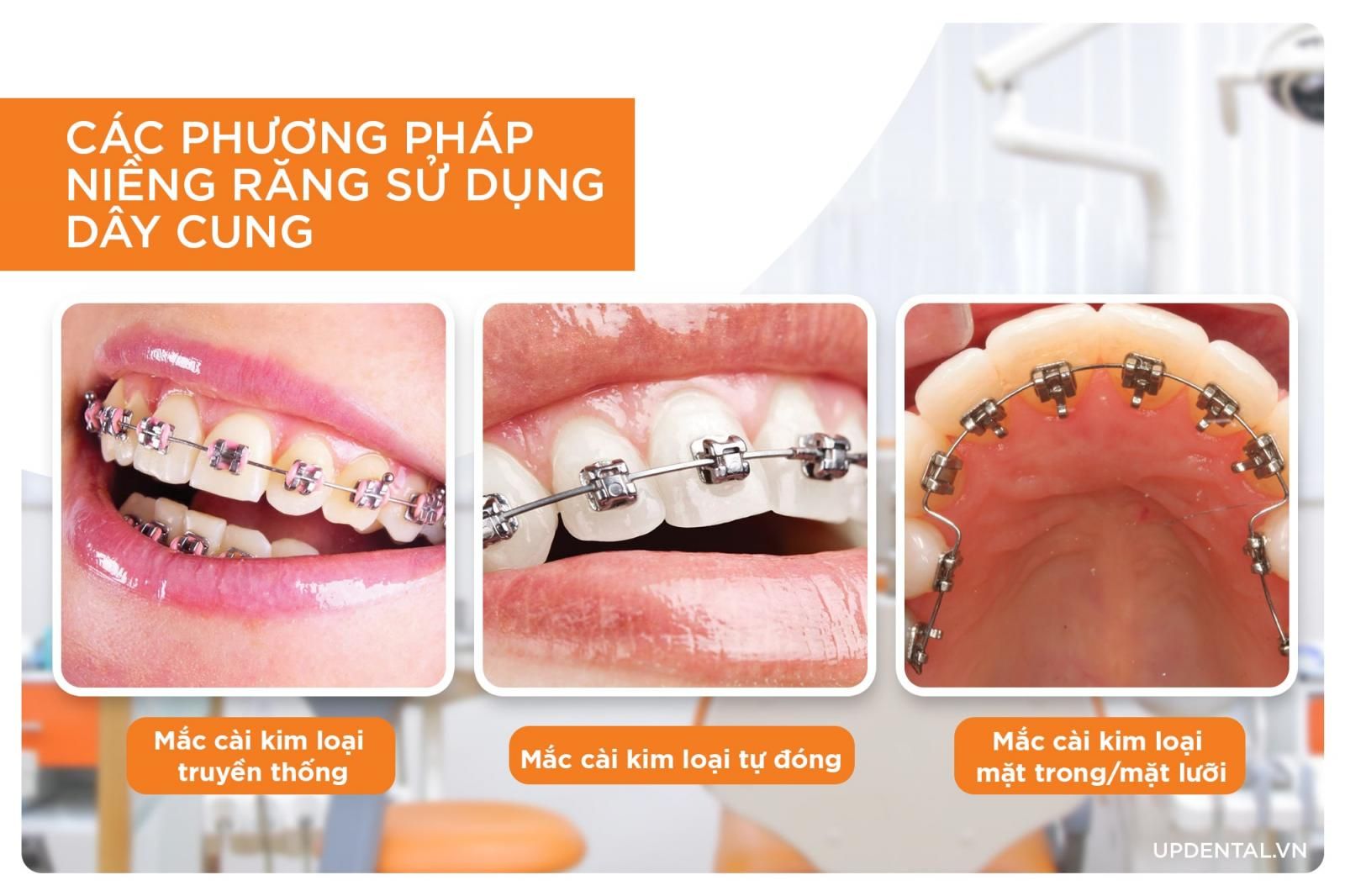 phương pháp niềng răng sử dụng dây cung