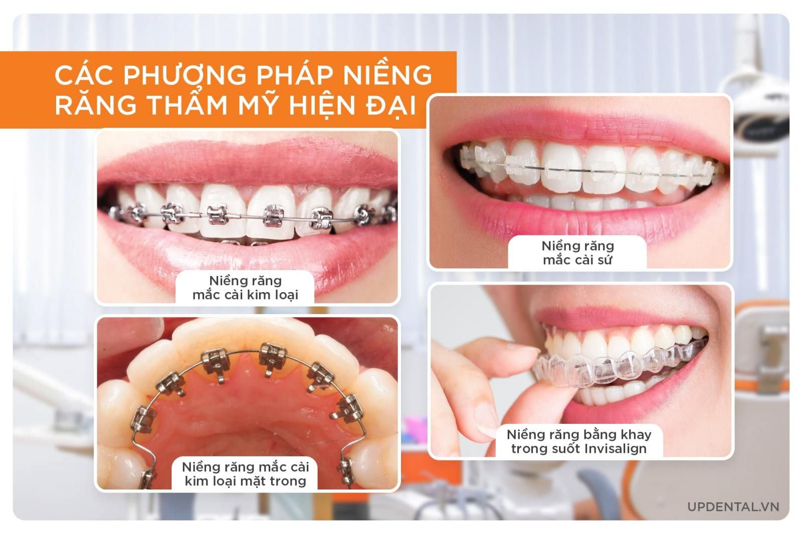 các phương pháp niềng răng thẩm mỹ