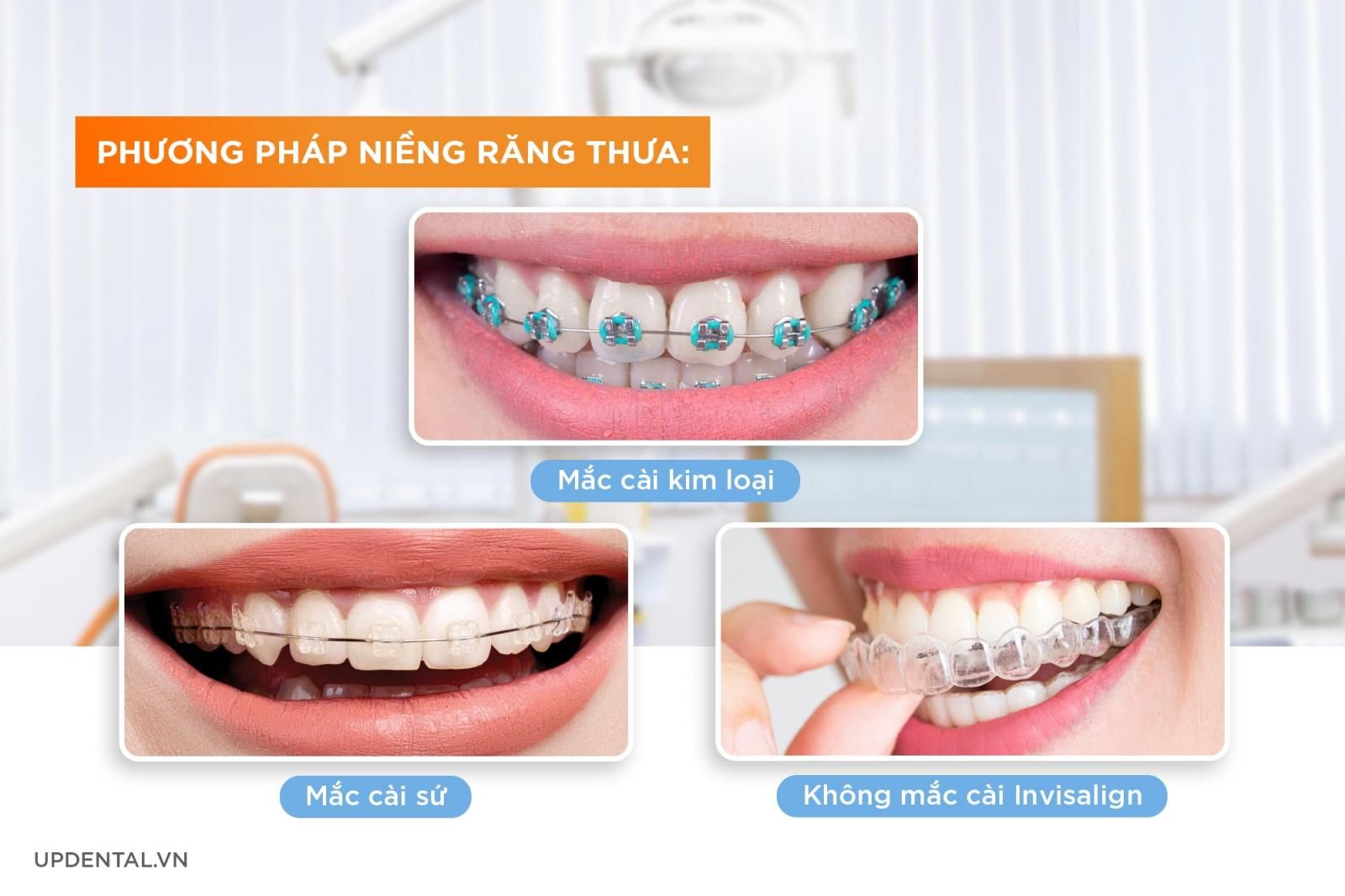 các phương pháp niềng răng thưa