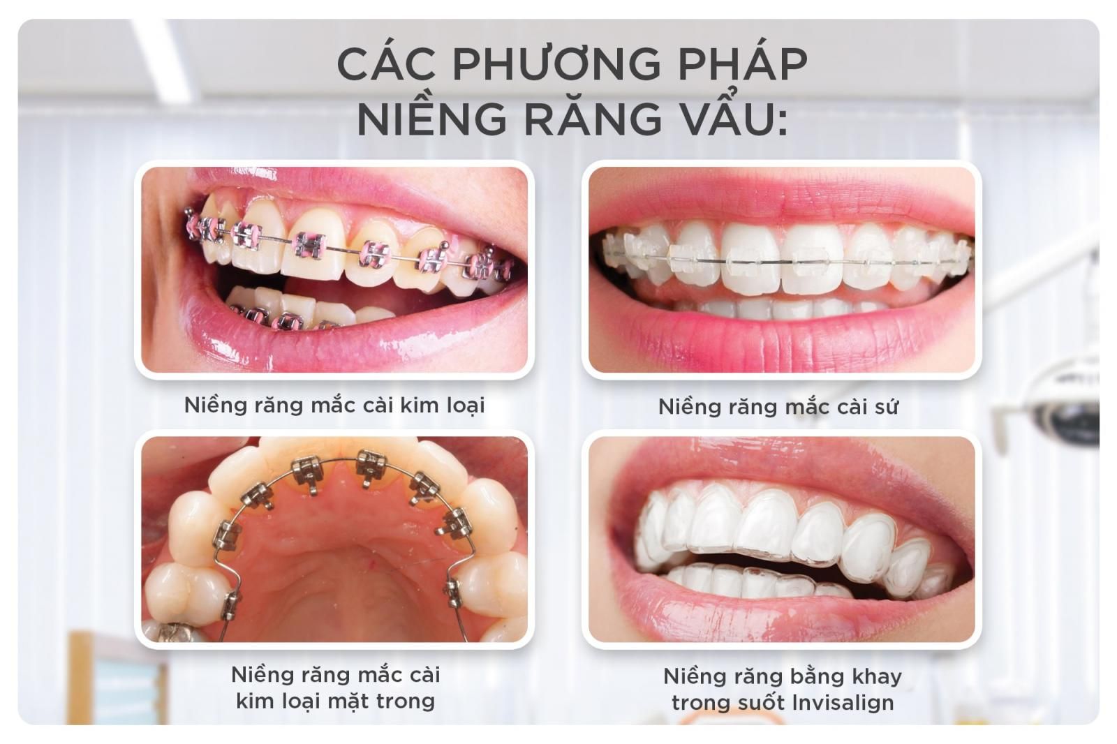 các phương pháp niềng răng vẩu