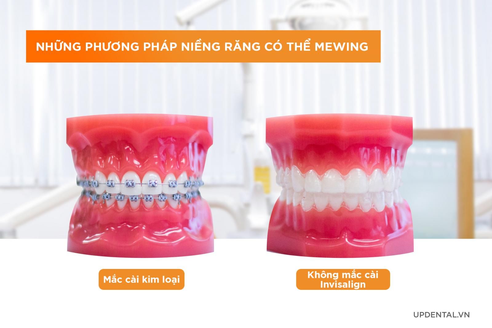 Phương pháp niềng răng có thể mewing