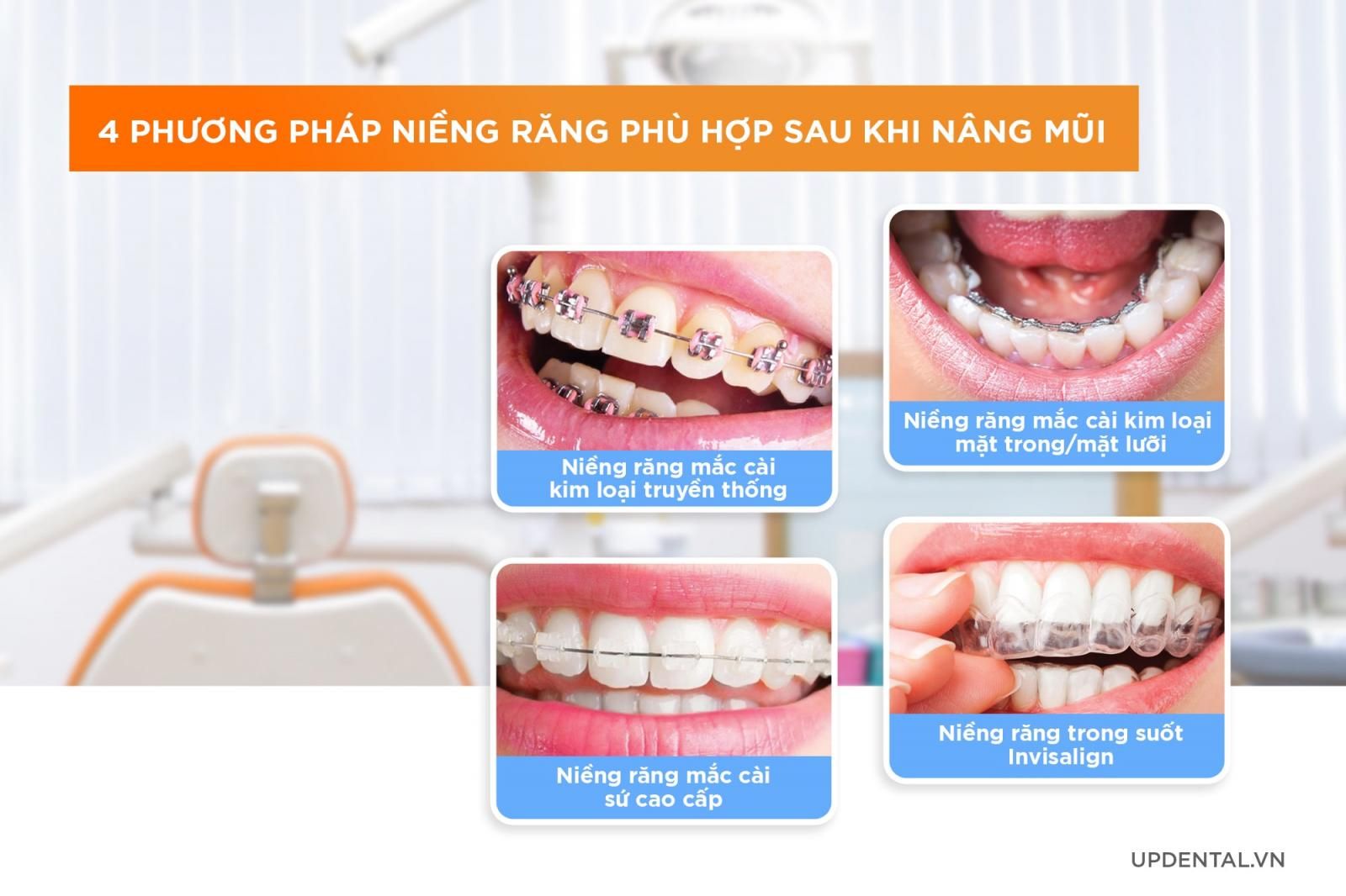 Phương pháp niềng răng nâng mũi