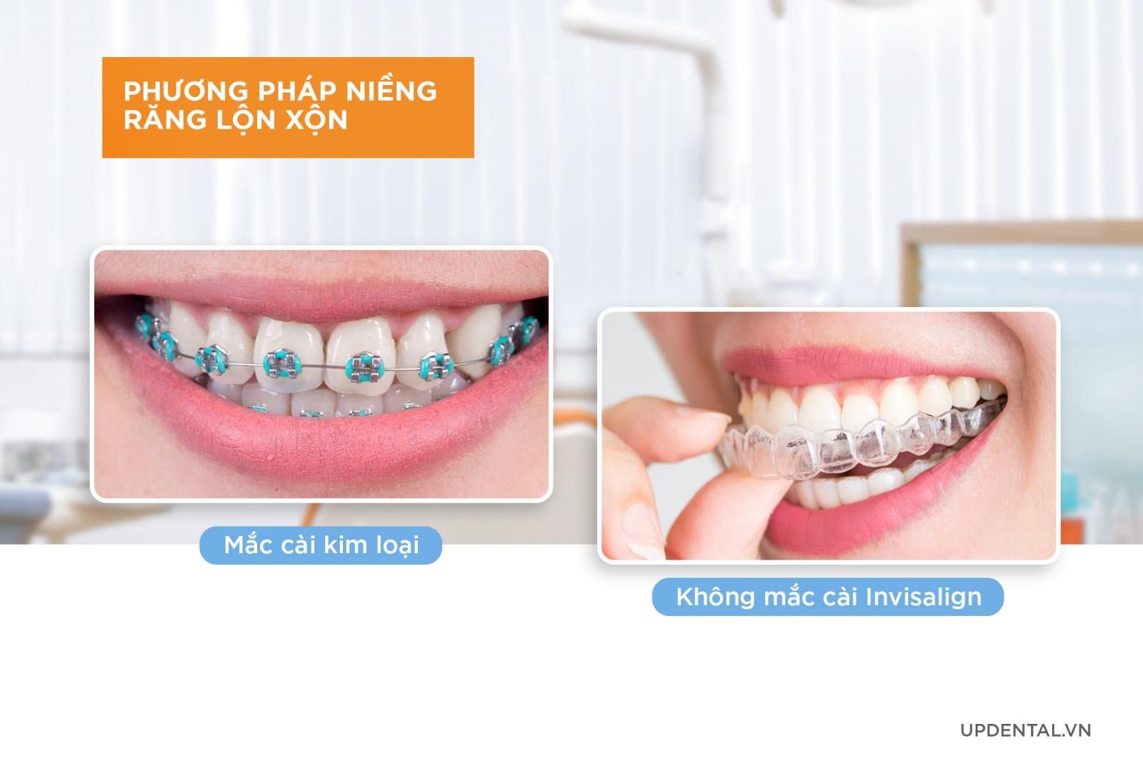 Phương pháp niềng răng lộn xộn