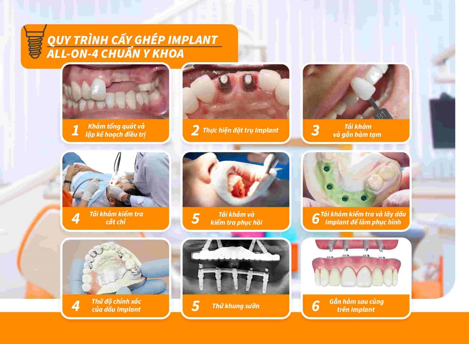 Quy trình cấy ghép Implant All-on-4 chuẩn Y khoa