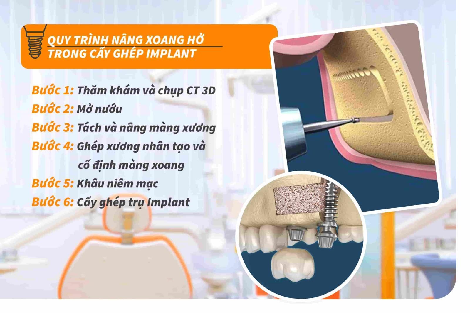 Quy trình nâng xoang hở trong cấy ghép Implant