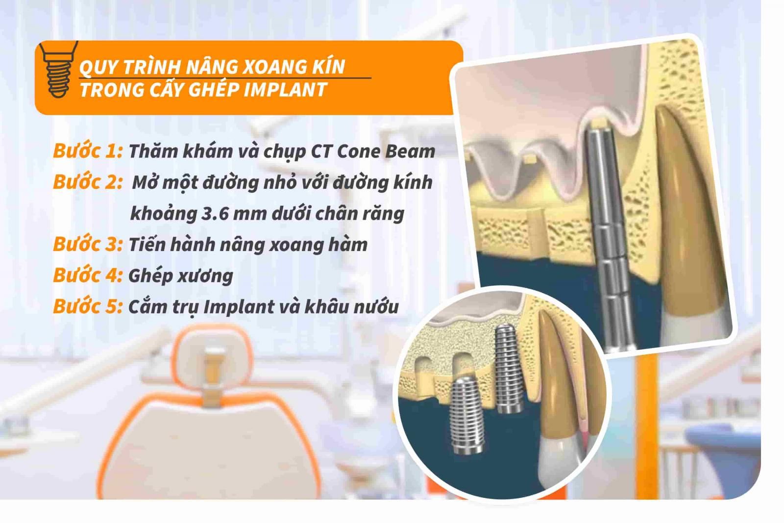 Quy trình nâng xoang kín trong cấy ghép Implant