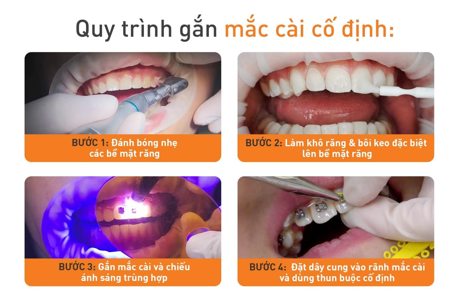 Quy trình niềng răng cố định