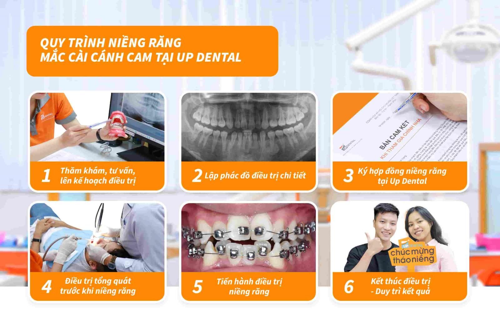 Quy trình niềng răng mắc cài cánh cam tại Up Dental