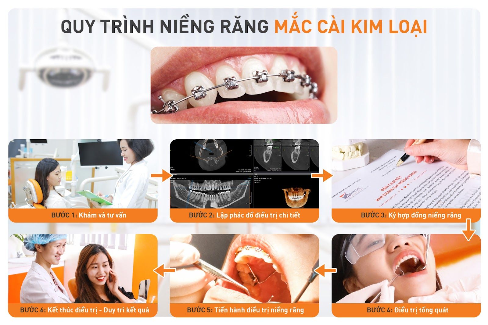 Quy trình niềng răng mắc cài chuẩn y khoa tại Up Dental