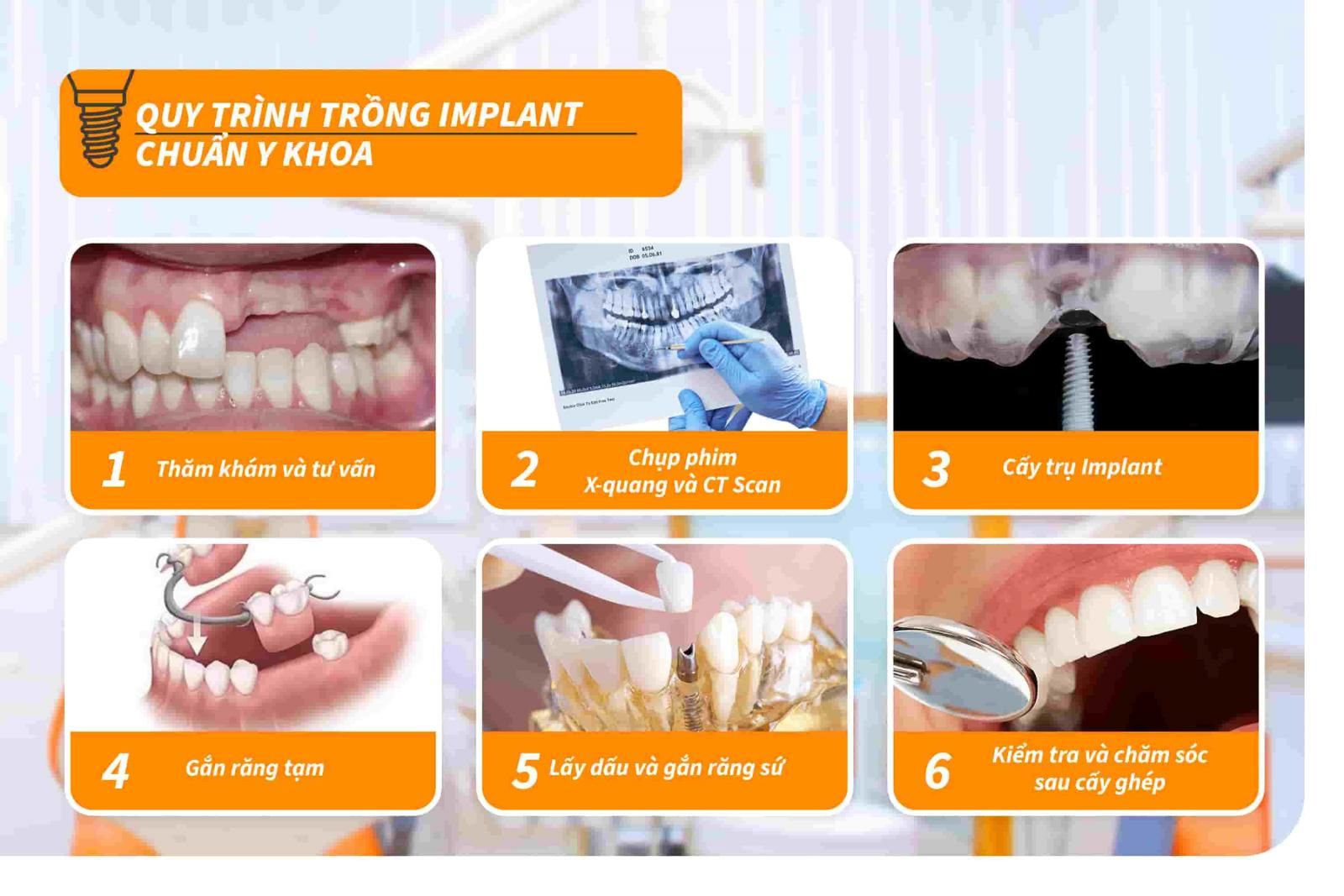 Quy trình trồng Implant chuẩn Y khoa