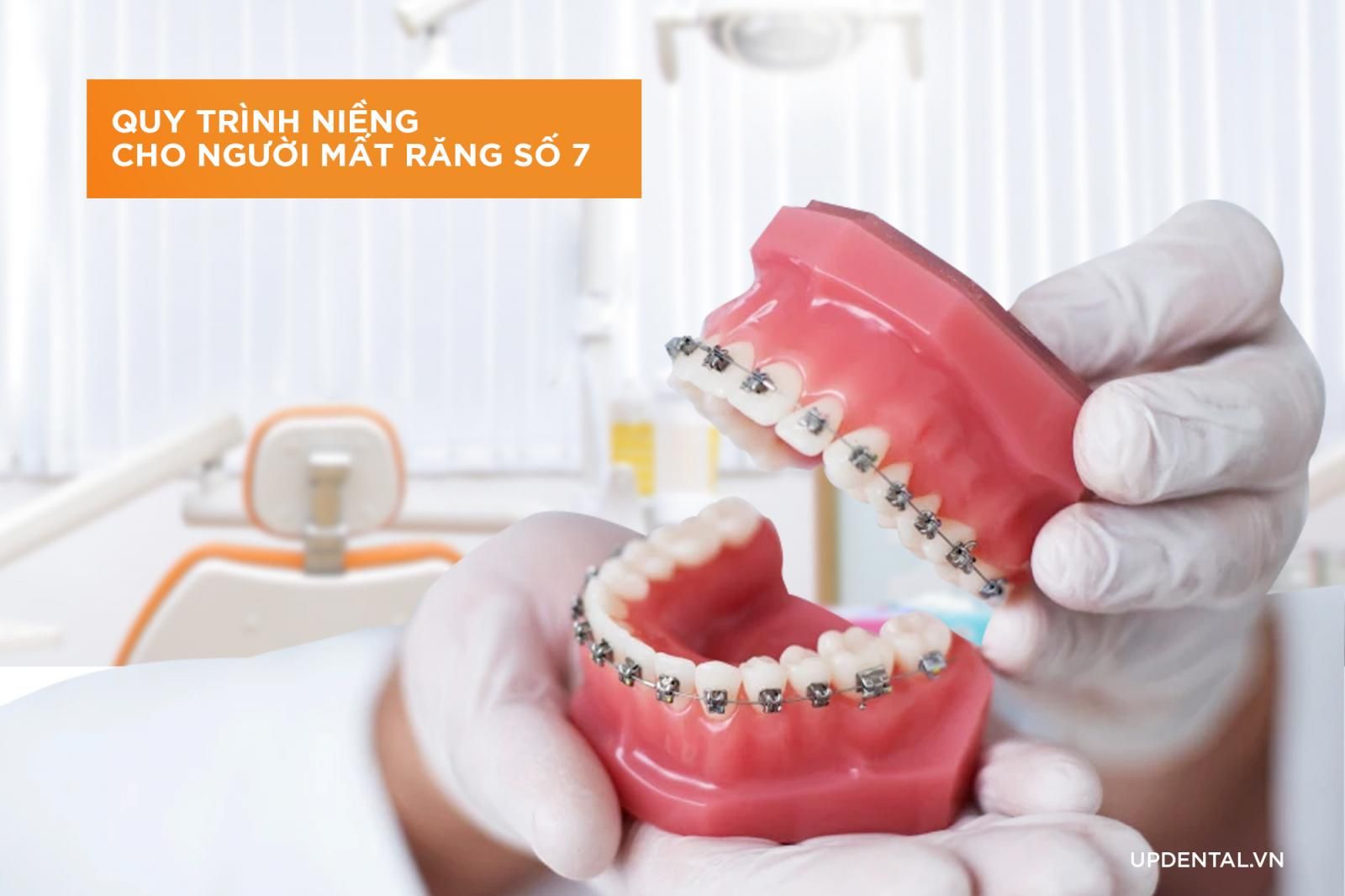 Quy trình niềng răng cho người mất răng số 7