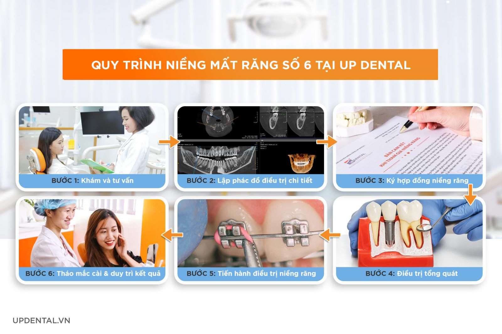 Quy trình niềng răng khi mất răng số 6