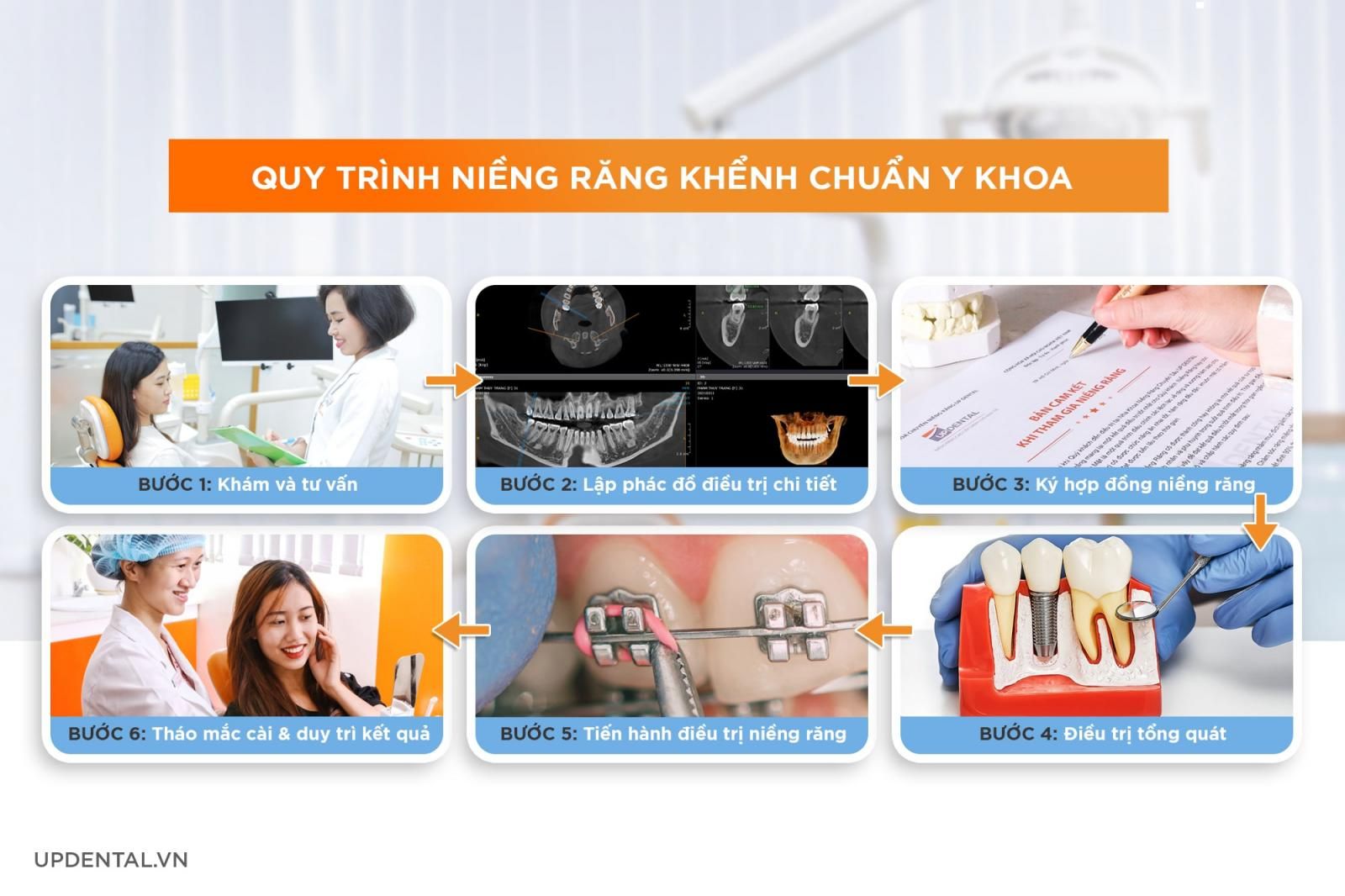 Quy trình niềng răng khểnh